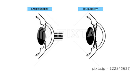 LASIK and ICL EVO 122845627