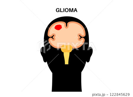 Glioma brain cancer 122845629