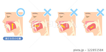 正しいミューイングの方法　適正な舌の位置と誤った舌の位置 122851584
