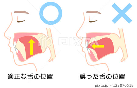 正しいミューイングの方法 適正な舌の位置と誤った舌の位置 正しいミューイングの方法 適正な舌の位置と誤った舌の位置 122870519