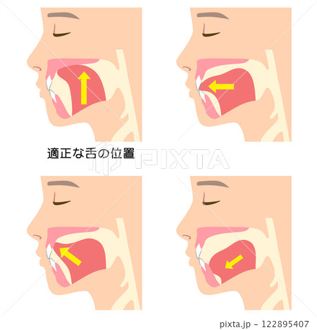 正しいミューイングの方法　適正な舌の位置と誤った舌の位置 122895407