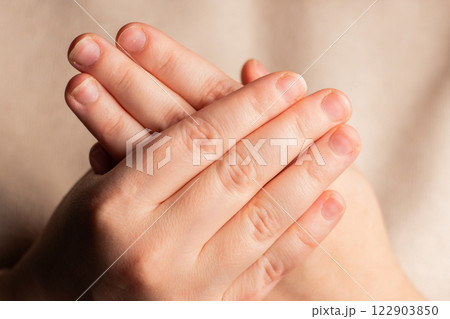 Woman showing her hands with bitten nails. Small nail plate. Poor manicure 122903850