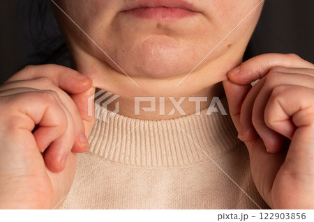 Close up image of female second chin. Overweight woman demonstrating second chin. Weight excess problem. Double chin correction surgery concept. Close up image of female second chin. Overweight woman demonstrating second chin. Weight excess problem. Double chin correction surgery concept. 122903856
