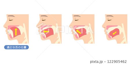 正しいミューイングの方法　適正な舌の位置と誤った舌の位置 122905462