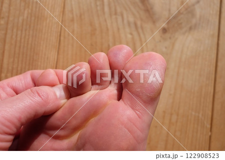 40代女性の足の裏のしもやけ 122908523