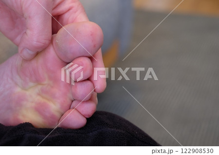 40代女性の足の裏のしもやけ 122908530