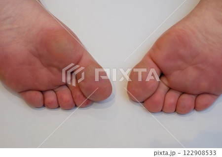 40代女性の足の裏のしもやけ 40代女性の足の裏のしもやけ 122908533