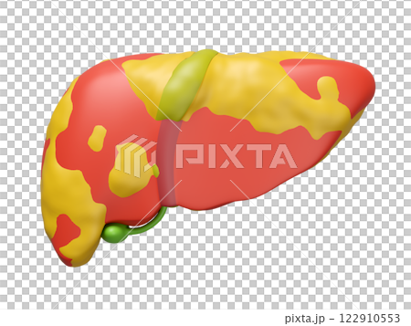 3d fatty liver disease isolated. 3d illustration render 122910553