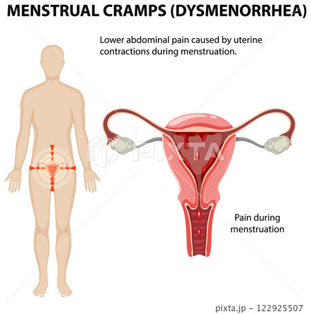 Understanding Menstrual Cramps and Dysmenorrhea 122925507