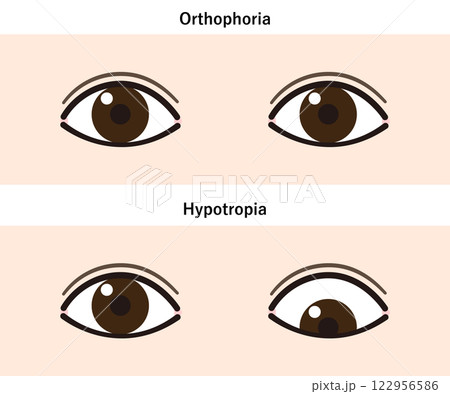 下斜視のイラスト(Strabismus/Hypotropia) 下斜視のイラスト(Strabismus/Hypotropia) 122956586