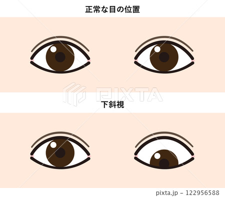 下斜視と正常な目の比較イラスト 122956588