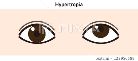 上斜視のイラスト(Strabismus/Hypertropia) 上斜視のイラスト(Strabismus/Hypertropia) 122956589