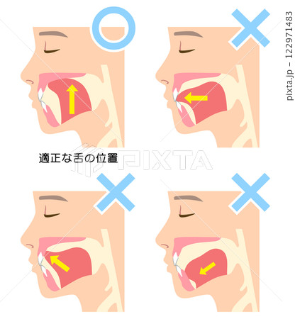 正しいミューイングの方法　適正な舌の位置と誤った舌の位置 122971483