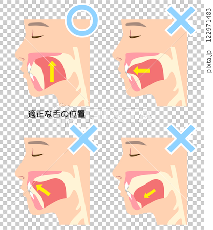 正しいミューイングの方法　適正な舌の位置と誤った舌の位置 122971483
