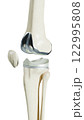 Total Knee Replacement is surgery to replace diseased or damaged joint surfaces of the knee with metal and plastic prosthetic devices. 122995808