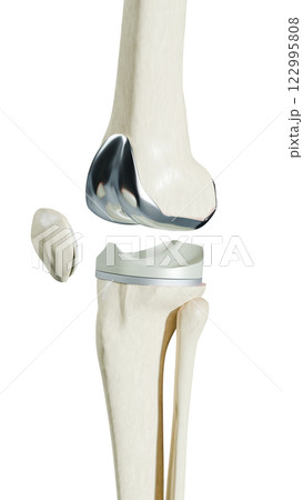 Total Knee Replacement is surgery to replace diseased or damaged joint surfaces of the knee with metal and plastic prosthetic devices. 122995808