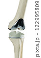 Total Knee Replacement is surgery to replace diseased or damaged joint surfaces of the knee with metal and plastic prosthetic devices.	 122995809