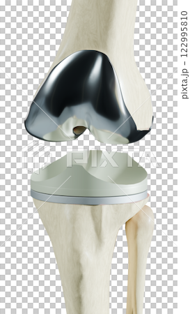 Total Knee Replacement is surgery to replace diseased or damaged joint surfaces of the knee with metal and plastic prosthetic devices. 122995810