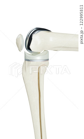 Total Knee Replacement is surgery to replace diseased or damaged joint surfaces of the knee with metal and plastic prosthetic devices. 122995811