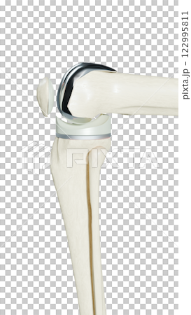 Total Knee Replacement is surgery to replace diseased or damaged joint surfaces of the knee with metal and plastic prosthetic devices. 122995811