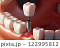 Dental implant screw, placement procedure 122995812