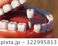 Dental implant screw, placement procedure 122995813