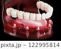 Dental implant screw, placement procedure 122995814
