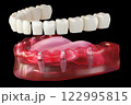 Dental implant screw, placement procedure 122995815