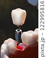 Dental implant screw, placement procedure 122995816