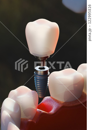 Dental implant screw, placement procedure 122995816