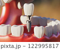 Dental implant screw, placement procedure 122995817