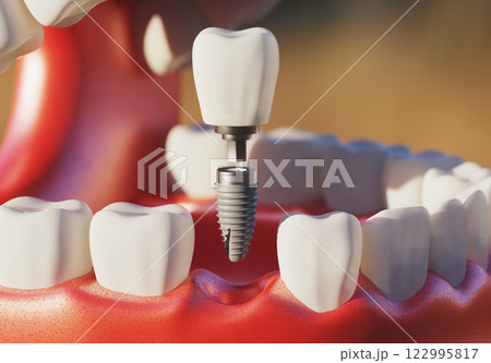 Dental implant screw, placement procedure 122995817