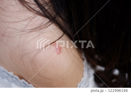 Close up BCG vaccination scars awaken an abscess on shoulder of Asian woman. Bacillus Calmette Gurin vaccine Close up BCG vaccination scars awaken an abscess on shoulder of Asian woman. Bacillus Calmette Gurin vaccine 122996198