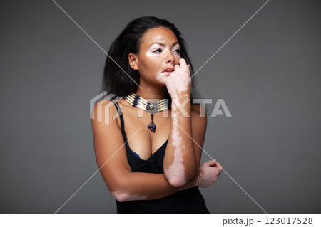Sensuous fashion model with vitiligo skin disease Sensuous fashion model with vitiligo skin disease 123017528