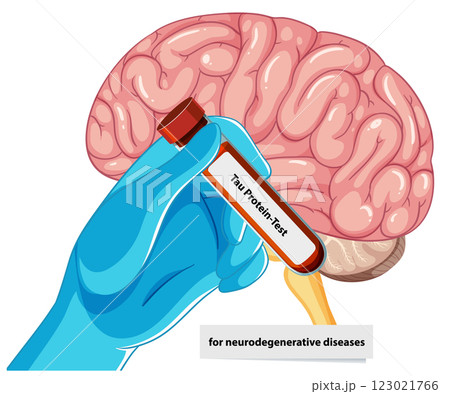 Tau Protein Test for Brain Health 123021766