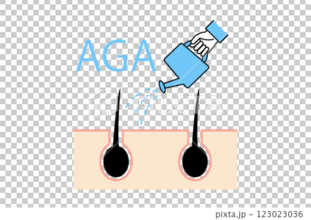 AGA 治療的插圖：一個人用噴壺將生髮劑塗抹在頭髮上 123023036