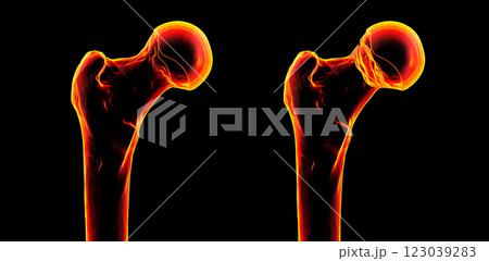 Subcapital femur fracture, 3D illustration 123039283