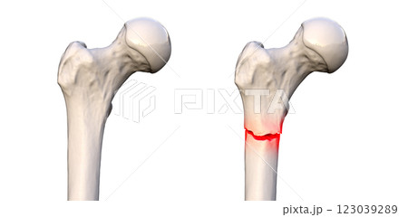 Subtrochanteric femur fracture, 3D illustration Subtrochanteric femur fracture, 3D illustration 123039289