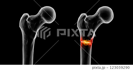 Subtrochanteric femur fracture, 3D illustration Subtrochanteric femur fracture, 3D illustration 123039290
