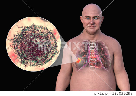 Lung cancer, 3D illustration 123039295