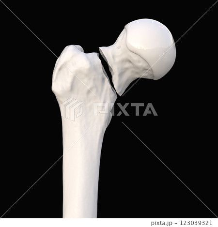 Transcervical femur fracture, 3D illustration 123039321