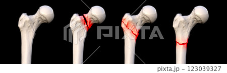 Femur fracture types: normal femur, femoral neck fracture, intertrochanteric fracture, and subtrochanteric fracture, 3D illustration. 123039327