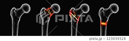 Femur fracture types: normal femur, femoral neck fracture, intertrochanteric fracture, and subtrochanteric fracture, 3D illustration. 123039328