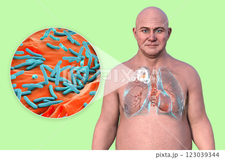 Cavitary tuberculosis, 3D illustration 123039344