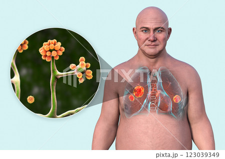 Lung mucormycosis and close-up view of Cunninghamella fungi, 3D illustration 123039349