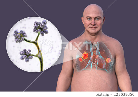 Lung mucormycosis and close-up view of Cunninghamella fungi, 3D illustration 123039350
