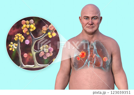 Lung mucormycosis and close-up view of Cunninghamella fungi, 3D illustration 123039351