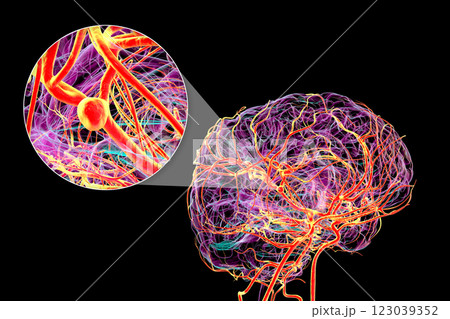 A saccular brain aneurysm, 3D illustration 123039352