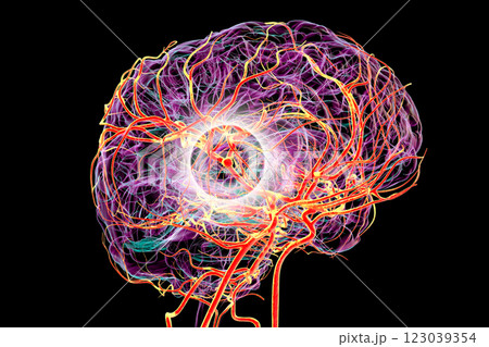A saccular brain aneurysm, 3D illustration 123039354