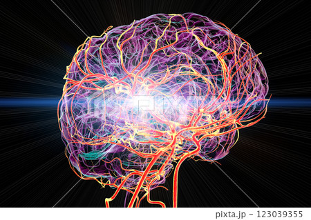 Brain stroke, conceptual 3D illustration 123039355